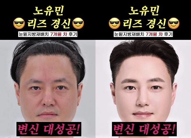 “10년 젊어진 얼굴”…노유민, 눈 밑 지방 재배치→민증 검사까지