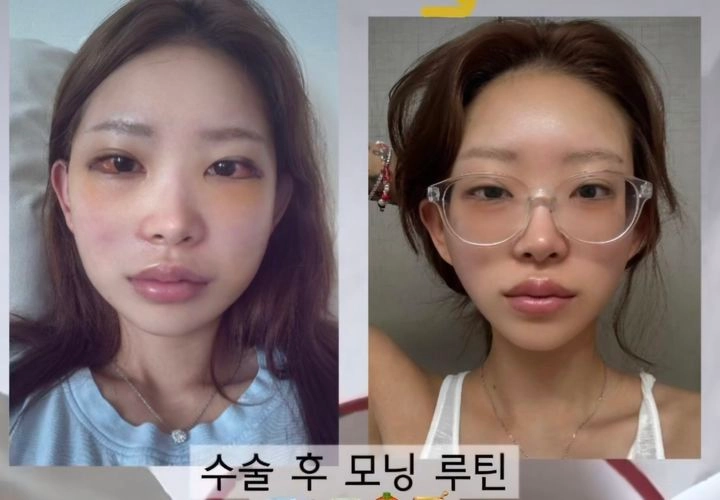 “얼굴 변화가 놀라워”…최준희, 성형 후 근황 공개→팬들 관심 집중