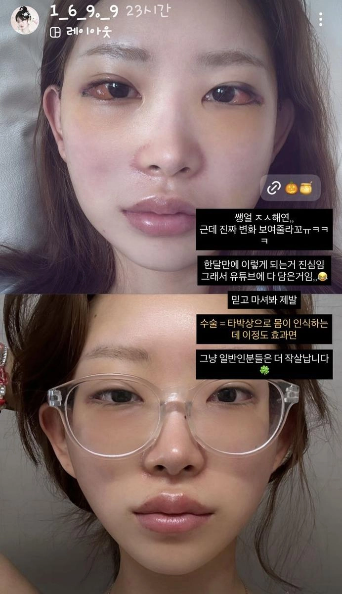 “수술 후 또 다른 매력”…최준희, 안면 윤곽·눈 변화→청순미에 물오른 분위기