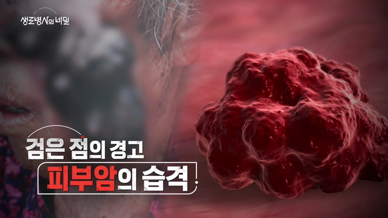 “검은 점의 신호”…‘생로병사의 비밀’ 환자 사례, 피부암의 경고→조기 발견이 살린다 / KBS