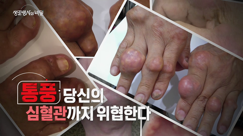 “평생 관리의 무게”…‘생로병사의 비밀’ 통풍 환자들, 청년부터 장년까지→심혈관 위기 경고 / KBS