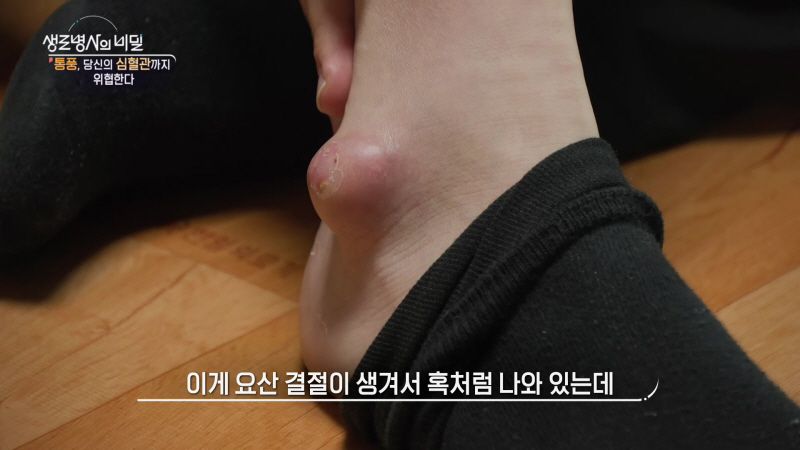 “통증의 왕은 끝나지 않는다”…생로병사의 비밀 통풍 환자들, 극한의 고통→전신 건강 위협까지 / KBS