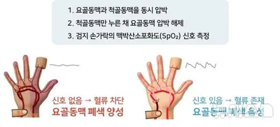 “니트로글리세린으로 예방 성공”…서울대병원, 영유아 요골동맥 폐색률 3분의 1로