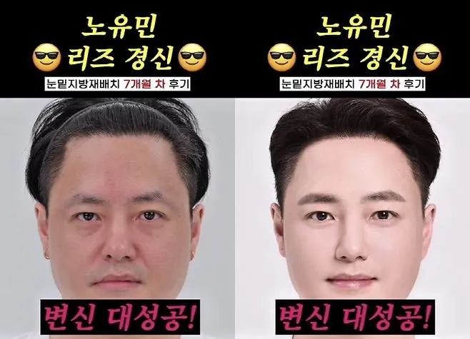 “10년 젊어진 얼굴”…노유민, 눈 밑 지방 재배치→민증 검사까지